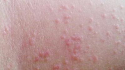 湿疹和汗疹的区别图片 西瓜视频