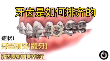 怎么矫正龅牙视频 西瓜视频