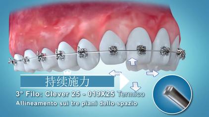 拔牙矫正收缝过程动画 西瓜视频